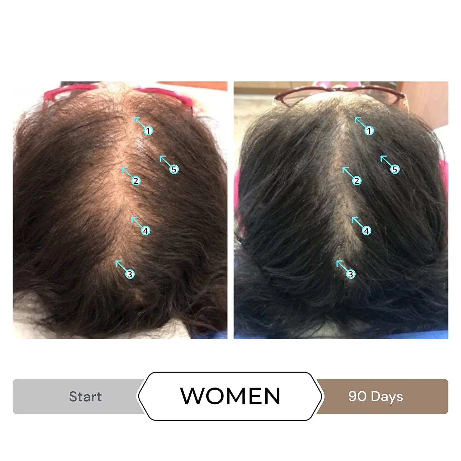 Revita Shampoo w/Biotin, Caffeine and Hair Growth Stimulating Ingredients, Helps Block DHT w/DNC-N Nanoxidil 5% Hair Regrowth Treatment